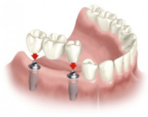 インプラント固定式入れ歯