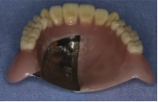 入れ歯の厚みを薄くする金属の総義歯