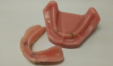 インプラントで安定させる総義歯