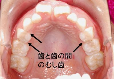 奥歯と奥歯の間（上顎）