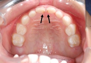 上顎の前歯と前歯の間