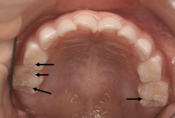 上顎の奥歯と奥歯の間